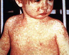 Measles paso robles