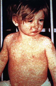 Measles paso robles