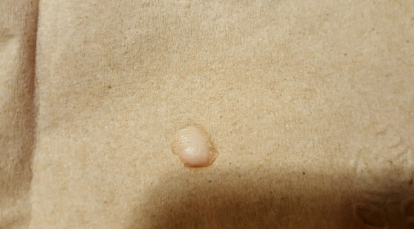 A photo of the fingertip allegedly found in the salad at the Paso Robles applebees.